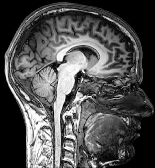 Analysis of diffusion MRI data